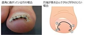 【送料無料】NEWまきづめリフト　爪やすり付き　巻きづめ　巻き爪矯正