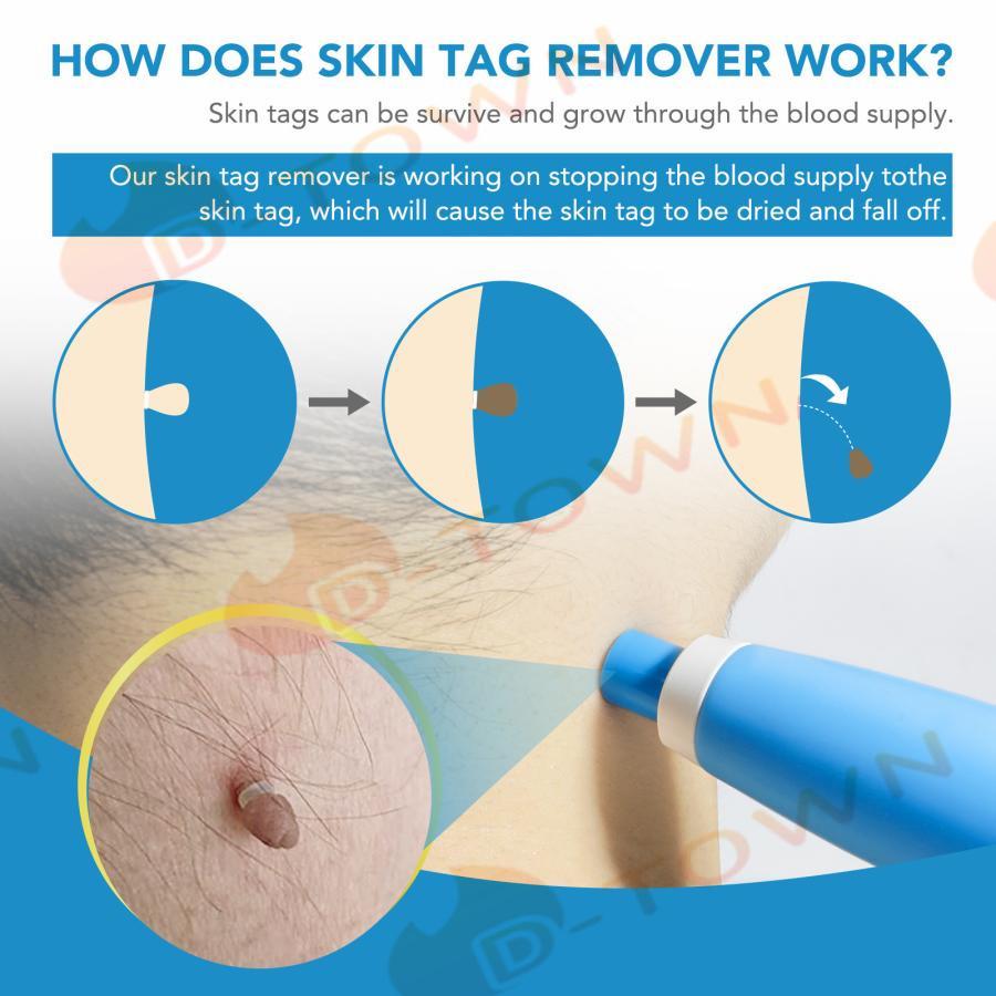 イボ Skin Tag Remover スキンタグ除去キットSEFUDUN 、2-8mm 家庭用いぼ除去装置、マイクロスキンタグ治療ツール、スキンケアツールセット