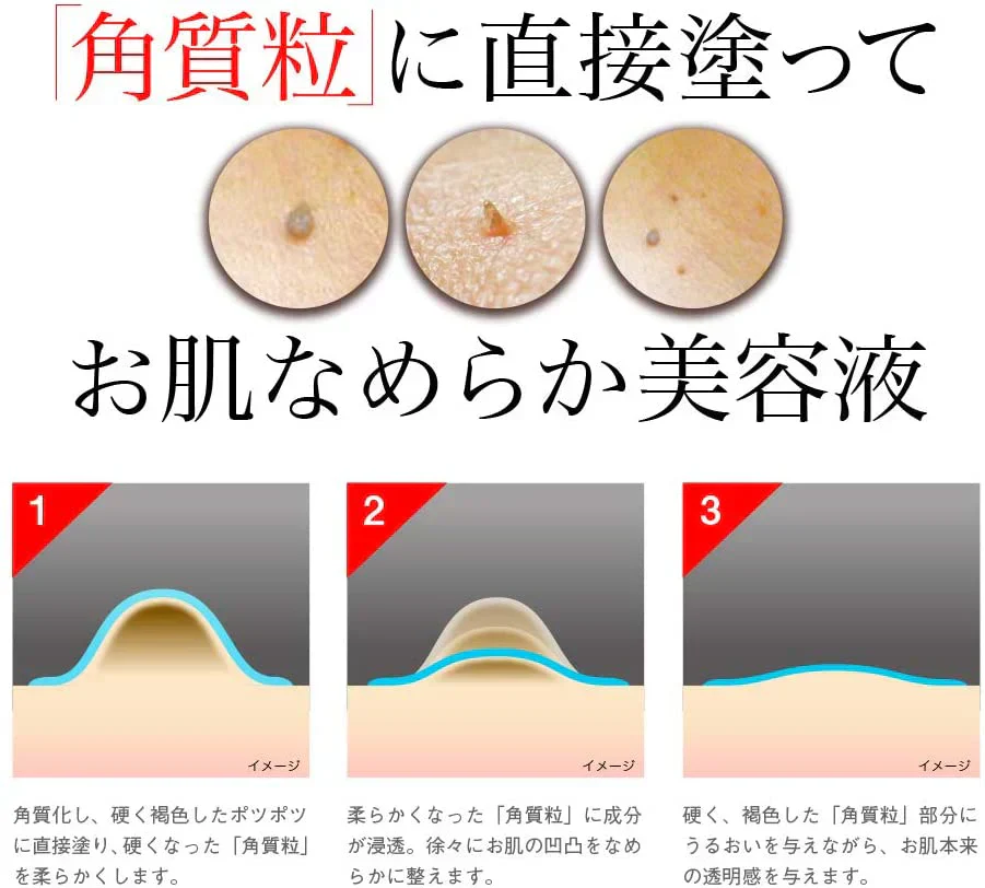 【激安お得4個セット】イポケアEX 美容液 角質 ケア スキンケア 顔 首筋 胸元 イボ ポツポツ バチルス発酵液 ヨクイニンエキス ウワウルシ葉エキス イポケア 送料無料 ポツポツ専用 美容液 いぼ取り 除去 お肌のポツポツ 角質 ケアバチルス発酵液 18ml　ポツポツ 角質粒　顔 首 肩 胸 美容 ケア お肌 ボディケア ぶつぶつ 日本製 イポケア イポケアＥＸ イボの悩み おすすめ 人気 ランキング 効果 強力 最強 角質ケア