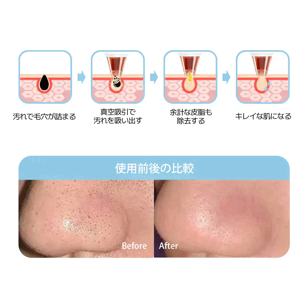 Sarlisi毛穴吸引器 毛穴ケア 光エステ サーリシ 美顔器 ニキビ イチゴ鼻対策 角栓取り 黒ずみ 毛穴クリーン 3段階吸引力調整 メンズ 角質ケア スキンケア ニキビ吸引 黒ずみ吸出し USB充電式 ４つの吸引ヘッド