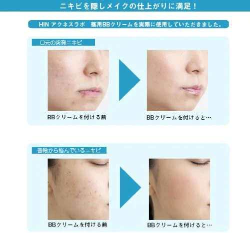 HINアクネスラボ薬用BBクリーム(ベージュ)【医薬部外品】35g