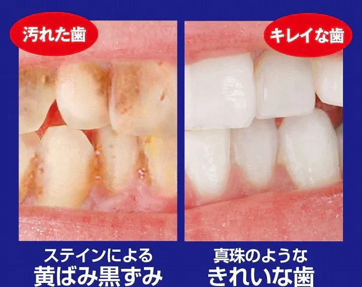 【薬用重曹ステインプロ】白い歯 自宅ケア ホワイトニング 自宅 簡単 歯の黄ばみ ヤニ 重曹 ポリン酸配合 簡単ケア 医薬部外品 オススメ プチプラ デンタルケア 通販 人気 ランキング アットコスメ おすすめ インスタ 話題 色素沈着 セルフ 口臭対策 口腔ケア デンタル オーラルケア 歯みがき 重曹 ミント マイノロジ