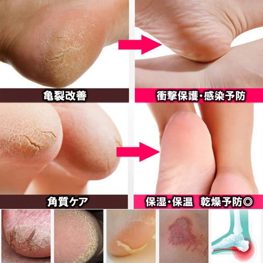 即納商品　左右セット かかと サポーター かかと 角質ケア かかと保護 やわらかシリコン 厚手 踵の痛み 足底筋膜 ひび割れ がさつき 改善 フットケア xjj2027290（2色各1ペア）