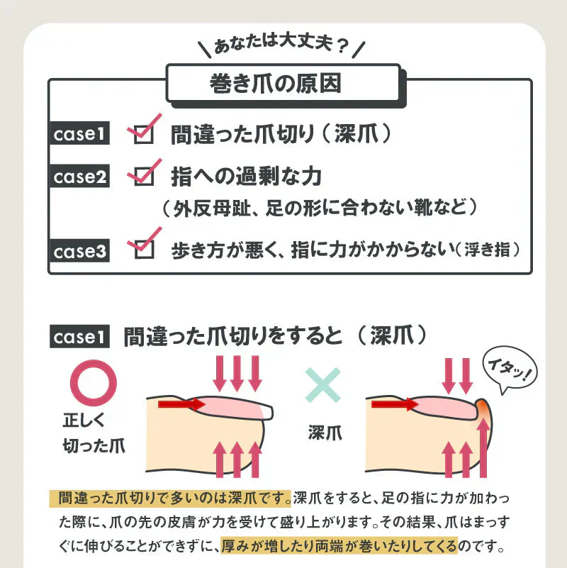 【やわらか巻き爪ガード】辛い巻き爪をしっかりサポート 巻き爪でお悩みの方におすすめ 歩くのが痛くてお出かけがツライ 爪切りが痛くてツライ  爪が痛くてお気に入りの靴が履けない巻き爪 クッション シリコン 保護テープ 深爪 浮き爪 外反母趾 矯正 親指 保護パット 痛み軽減 繰り返し使える 左右兼用 日本製  	 形状記憶特殊3Dシリコーンの反発力で巻き爪を引き上げ