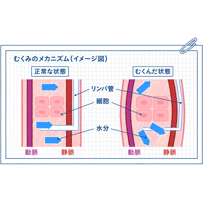 スリムウォーク認定販売店【メディカルリンパ（ハイソックス）（S~Mサイズ）】おそと用 血行促進 ひざ下 靴下 着圧 美脚 ピップ むくみ