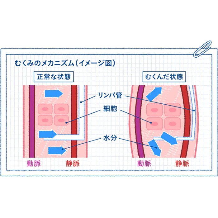 スリムウォーク認定販売店【メディカルリンパ（ストッキング）（SMサイズ）】おそと用 血行促進 着圧 美脚 ピップ むくみ