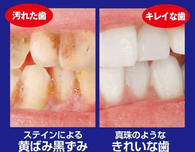薬用重曹ステインプロ ストロング30g【白い歯 自宅ケア 】ホワイトニング タバコや赤ワインなどのステイン汚れをしっかり浮き上がらせ、ピカピカに。自宅 簡単 歯の黄ばみ ヤニ 重曹 ポリン酸配合 簡単ケア 医薬部外品 オススメ プチプラ デンタルケア 通販 人気 ランキング アットコスメ おすすめ インスタ 話題 色素沈着 セルフ   口臭対策 口腔ケア デンタル オーラルケア 歯みがき 重曹 ミント マイノロジ 通常タイプよりも重曹3倍