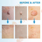 イボ Skin Tag Remover スキンタグ除去キットSEFUDUN 、2-8mm 家庭用いぼ除去装置、マイクロスキンタグ治療ツール、スキンケアツールセット