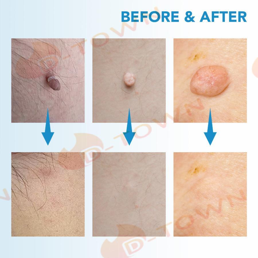イボ Skin Tag Remover スキンタグ除去キットSEFUDUN 、2-8mm 家庭用いぼ除去装置、マイクロスキンタグ治療ツール、スキンケアツールセット