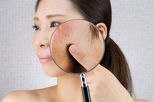 【つるつるたまご肌へ！】医薬部外品 薬用 ピーリングジェル シミケア 角質ケア しみ そばかす くすみ トーンアップ 日本製 / 薬用ノンシミンP 45g