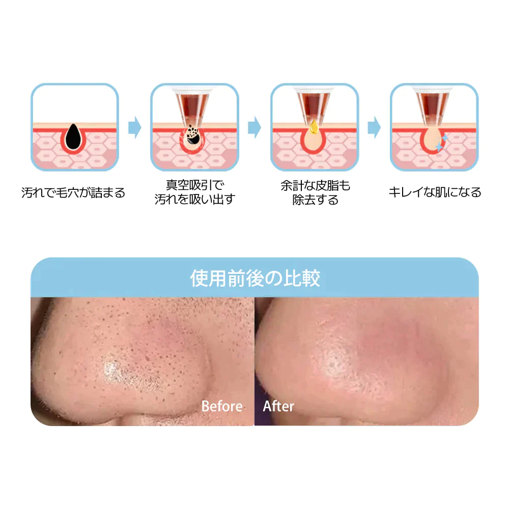 Sarlisi毛穴吸引器　3段階吸引力調整/USB充電式/４つの吸引ヘッド　サーリシ 毛穴ケア　ニキビ イチゴ鼻対策 角栓取り 黒ずみ 【ゲリラセール】