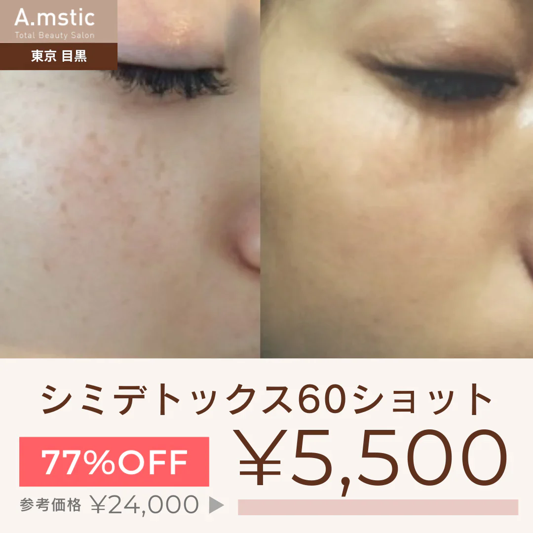 シミデトックス60ショット【美容サロンチケット】 エステ/美容/東京/目黒/A.mstic