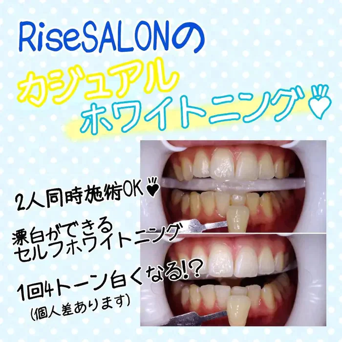マスクを外す前に！ 世界初超音波☆セルフホワイトニング12分×2照射　【美容サロンチケット】美容/エステ/ホワイトニング/東京/表参道/RiseSALON